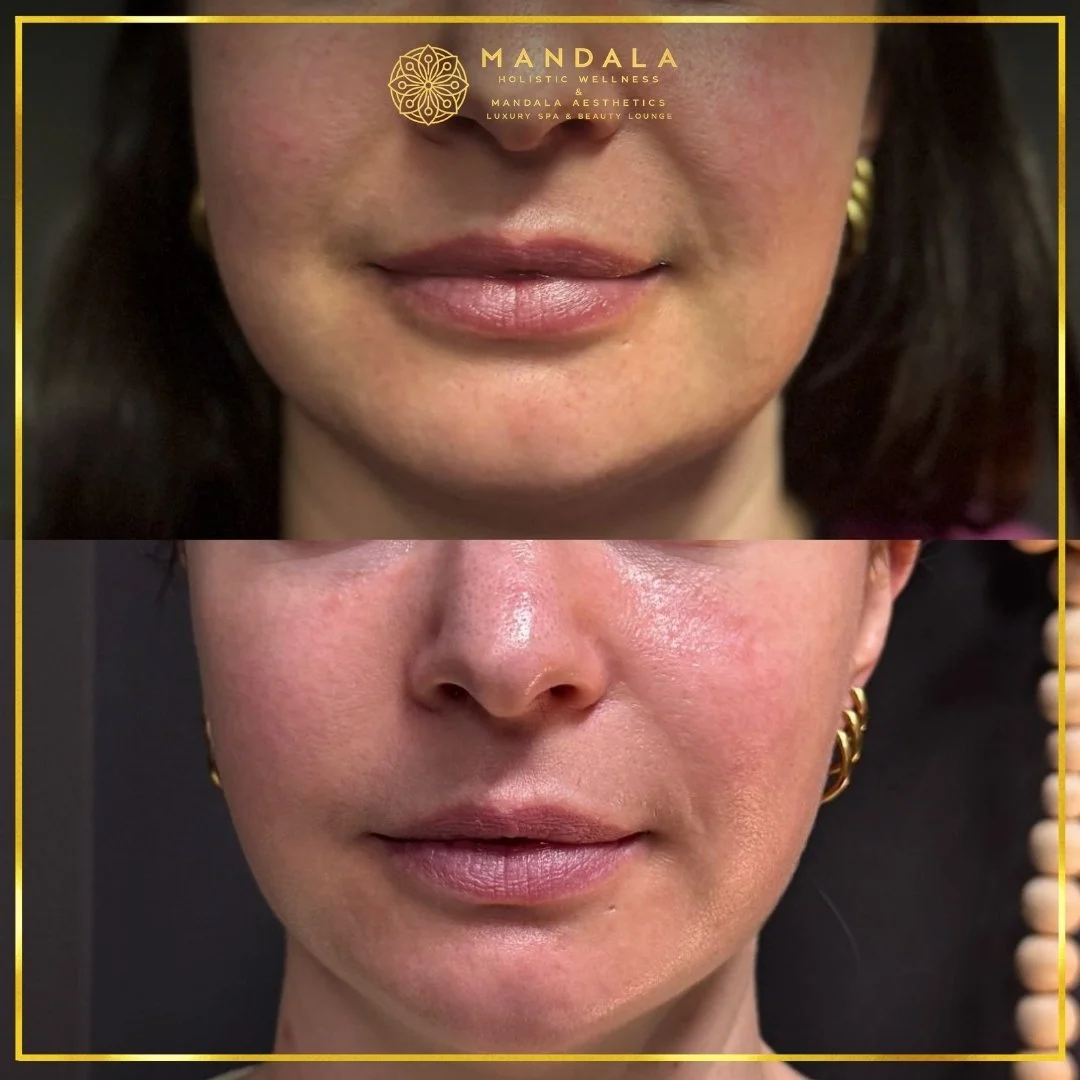 HIFU before and after results showing the lower face, chin and jawline at Mandala Aesthetics in Preston, Melbourne.
