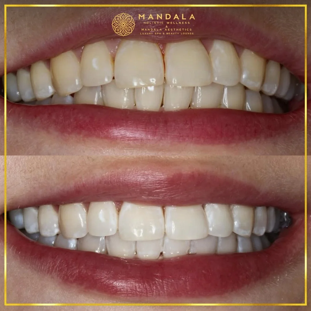 Teeth whitening before and after results showing a visibly white teeth,  brighter-looking smile at Mandala Aesthetics in Preston, Melbourne.