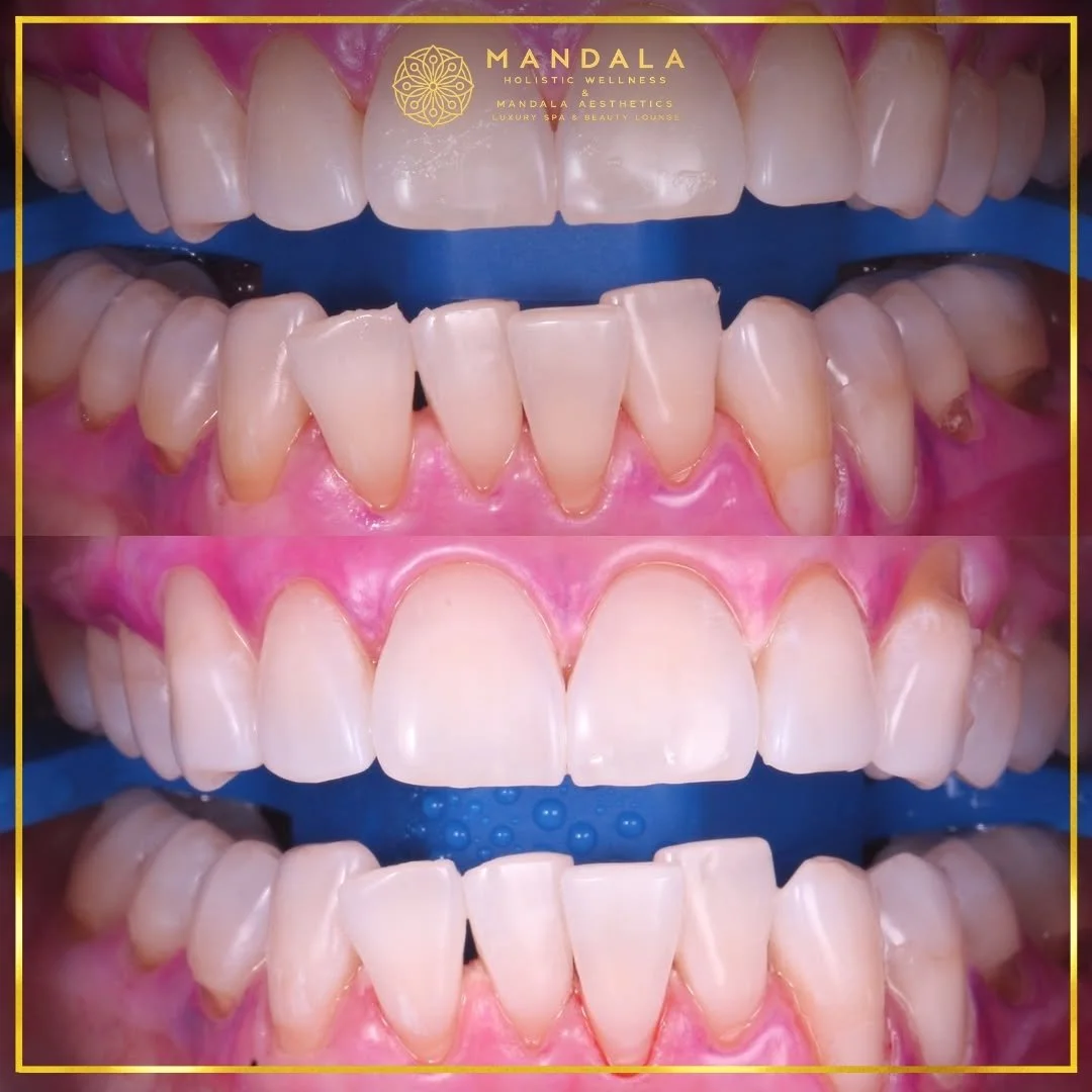 Teeth whitening before and after results showing a visibly white teeth,  brighter-looking smile at Mandala Aesthetics in Preston, Melbourne.