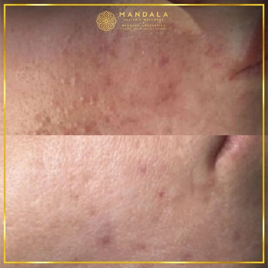 RF Microneedling before and after results showing improved-looking skin texture  and acne scars at Mandala Aesthetics in Preston, Melbourne.