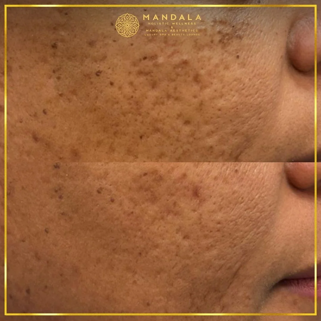 RF Microneedling before and after results showing improved-looking skin texture  and acne scars at Mandala Aesthetics in Preston, Melbourne.