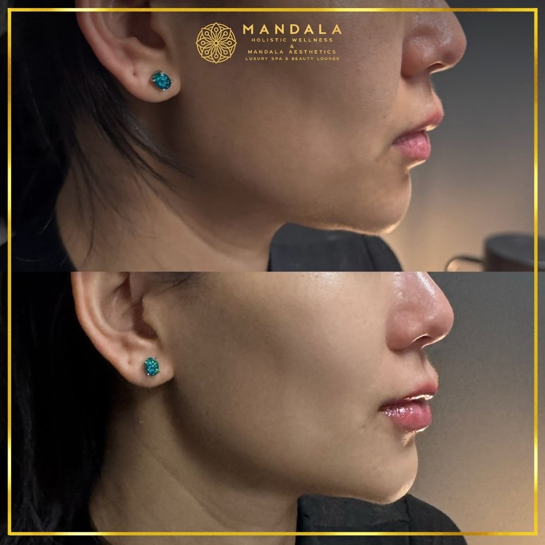 HIFU before and after results showing the lower face, chin and jawline at Mandala Aesthetics in Preston, Melbourne.