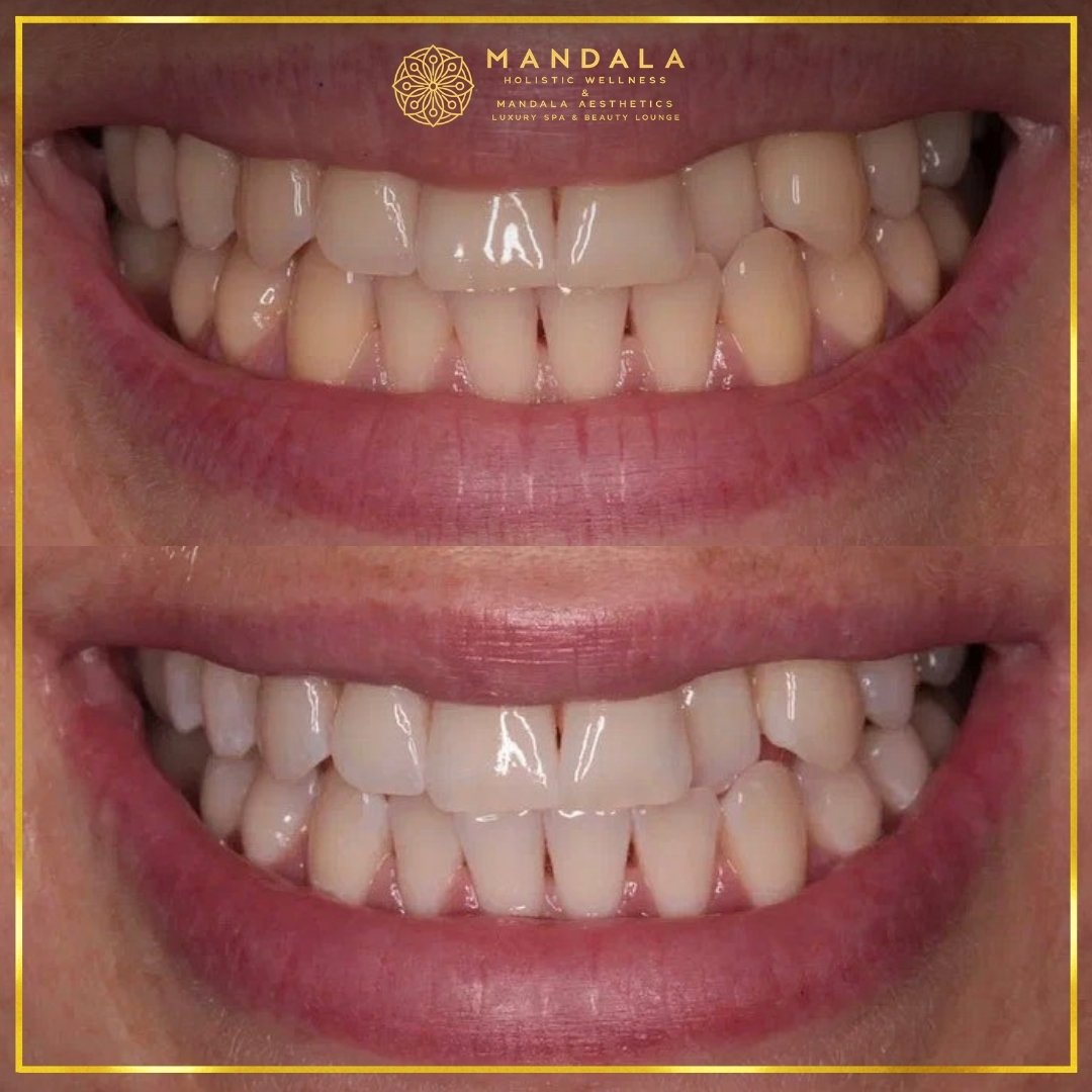 Teeth whitening before and after results showing a visibly white teeth,  brighter-looking smile at Mandala Aesthetics in Preston, Melbourne.