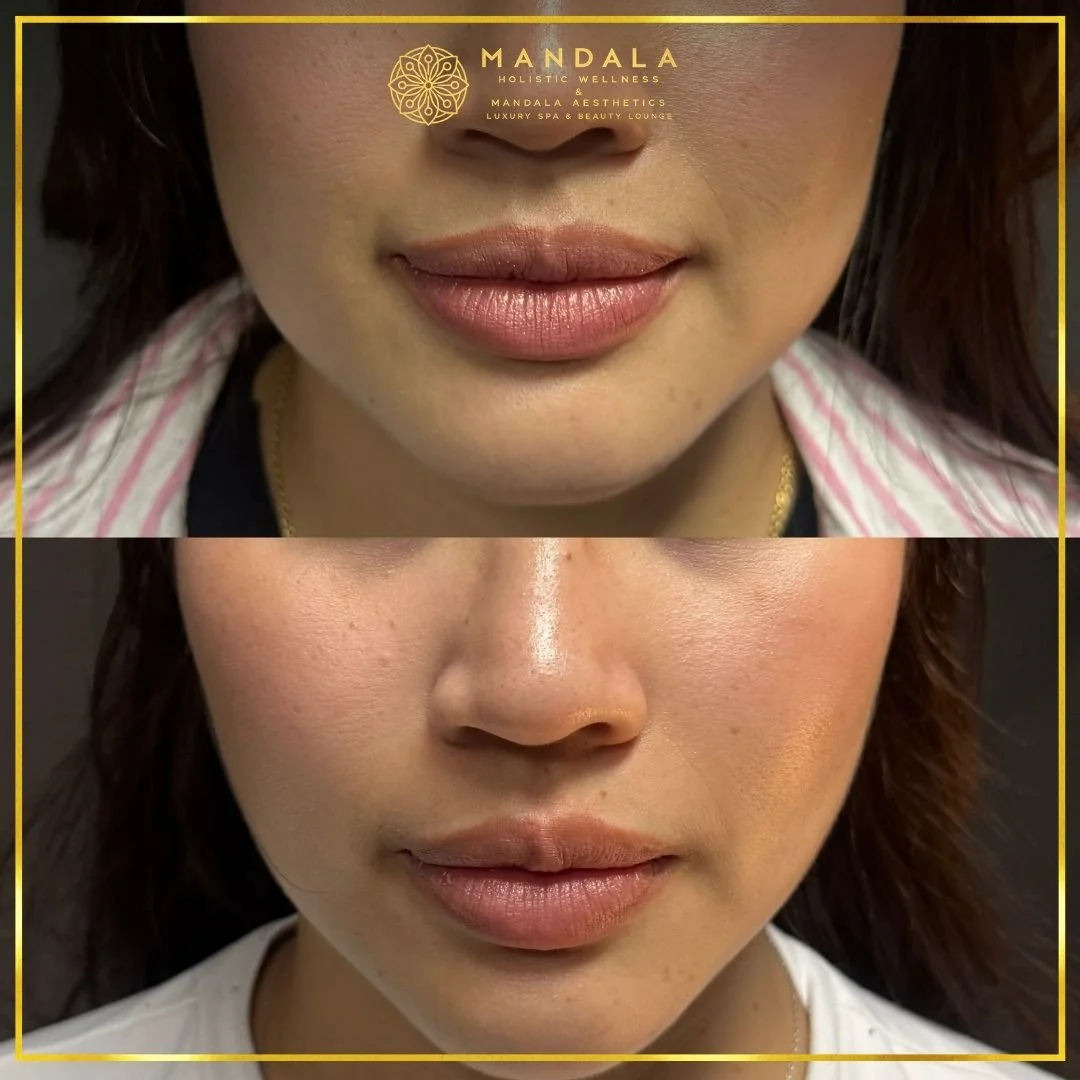 HIFU before and after results showing the lower face, chin and jawline at Mandala Aesthetics in Preston, Melbourne.