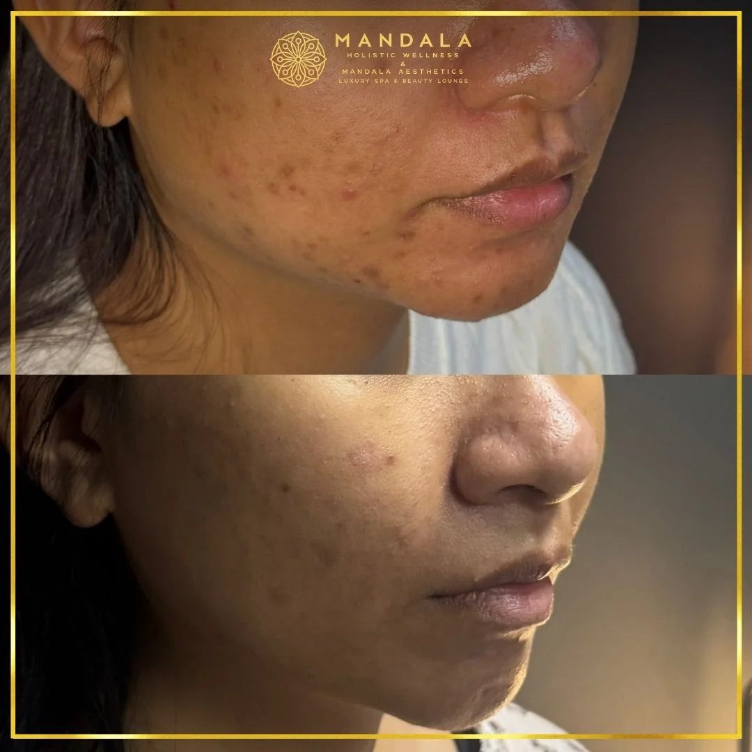HIFU before and after results showing the lower face, chin and jawline at Mandala Aesthetics in Preston, Melbourne.