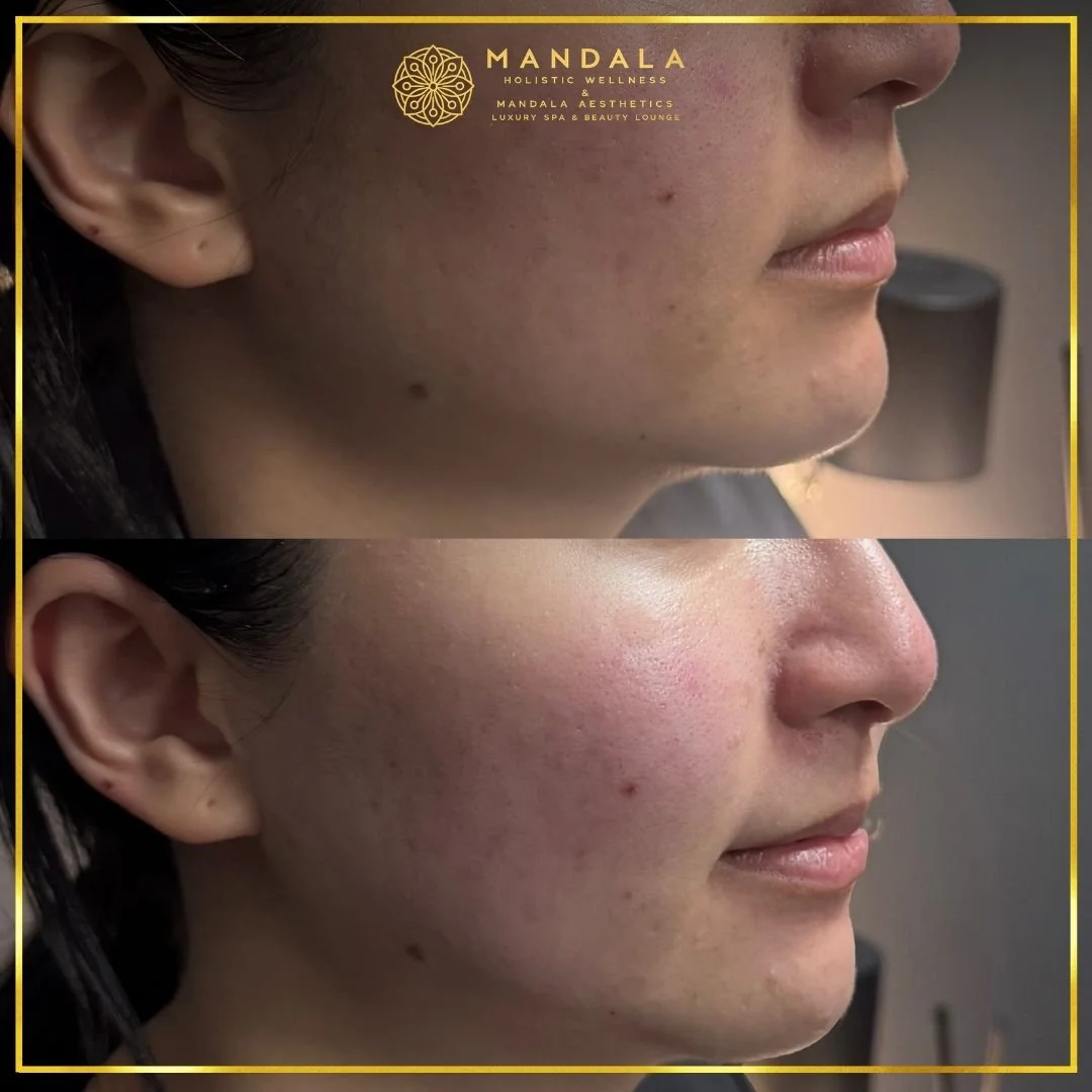HIFU before and after results showing the lower face, chin and jawline at Mandala Aesthetics in Preston, Melbourne.