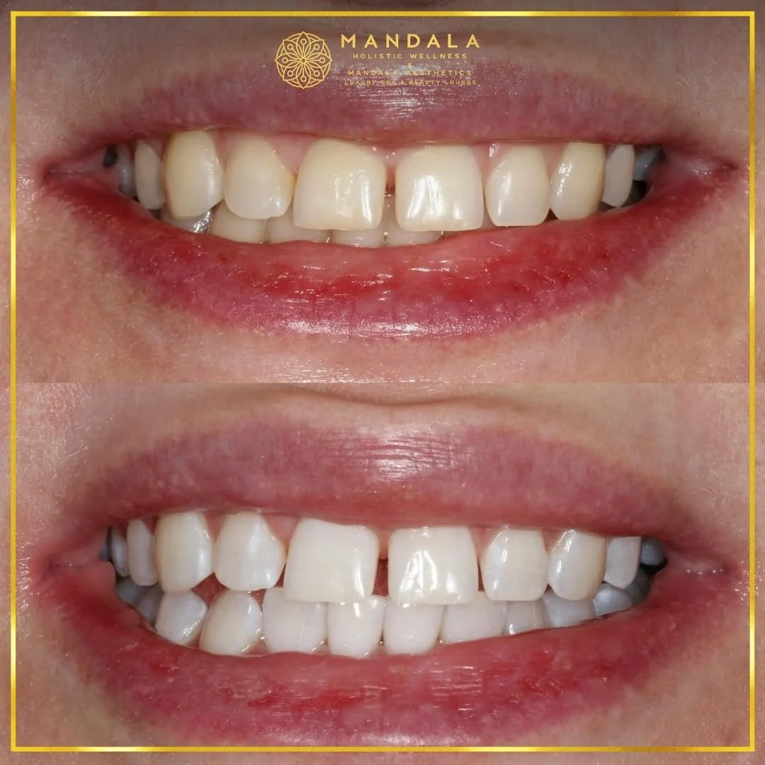 Teeth whitening before and after results showing a visibly white teeth,  brighter-looking smile at Mandala Aesthetics in Preston, Melbourne.