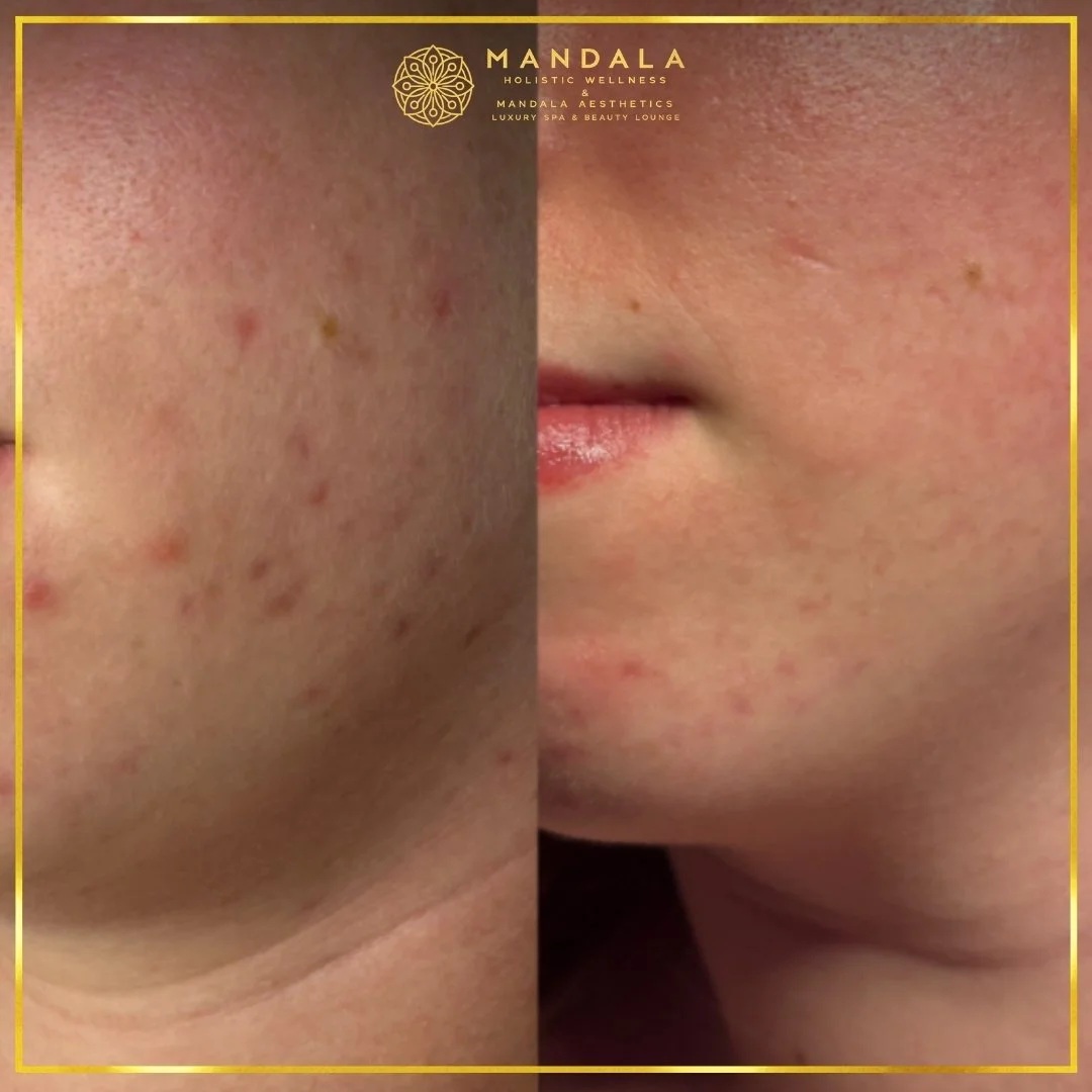 Facial treatment before and after results showing refreshed, hydrated and glowing-looking skin at Mandala Aesthetics in Preston, Melbourne.