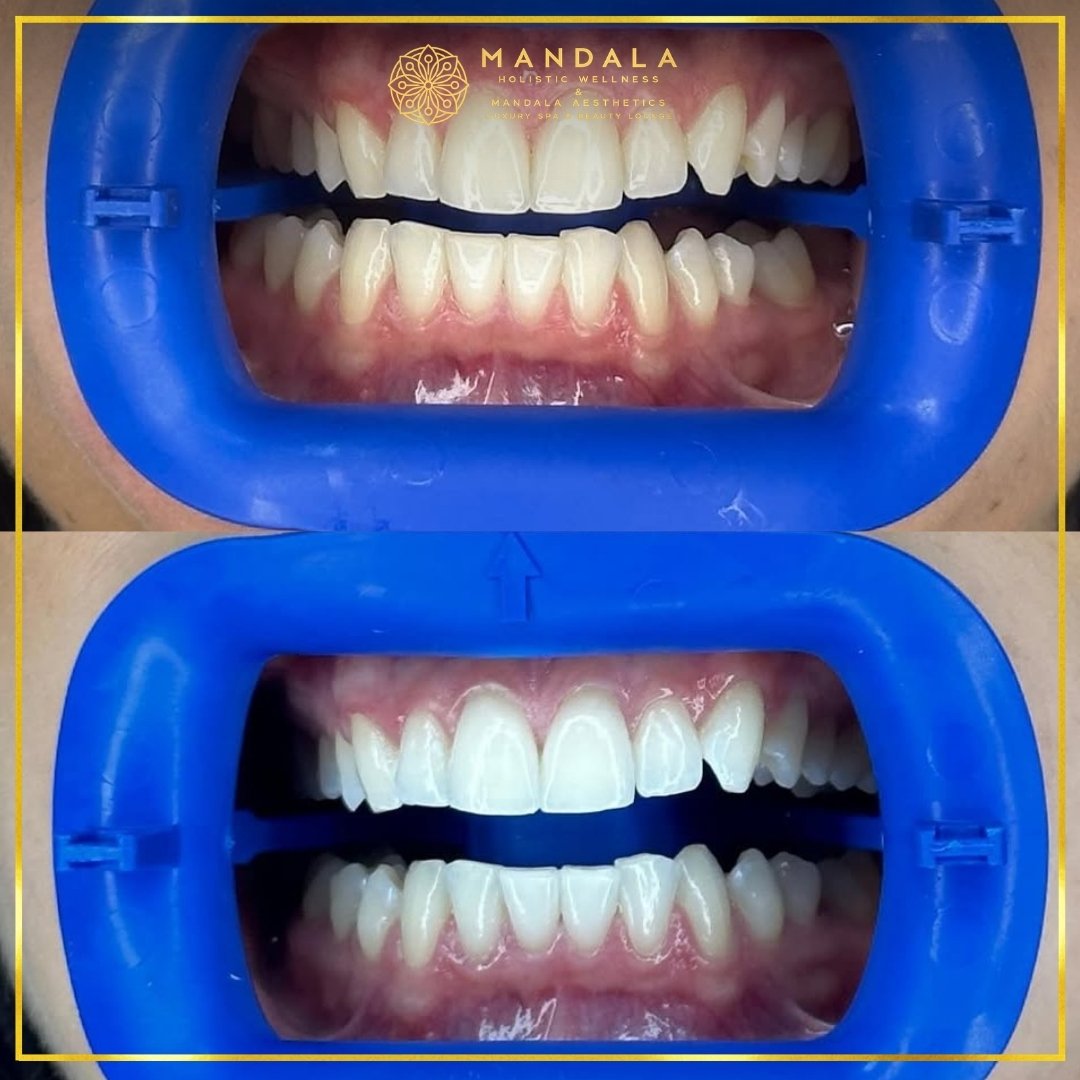 Teeth whitening before and after results showing a visibly white teeth,  brighter-looking smile at Mandala Aesthetics in Preston, Melbourne.