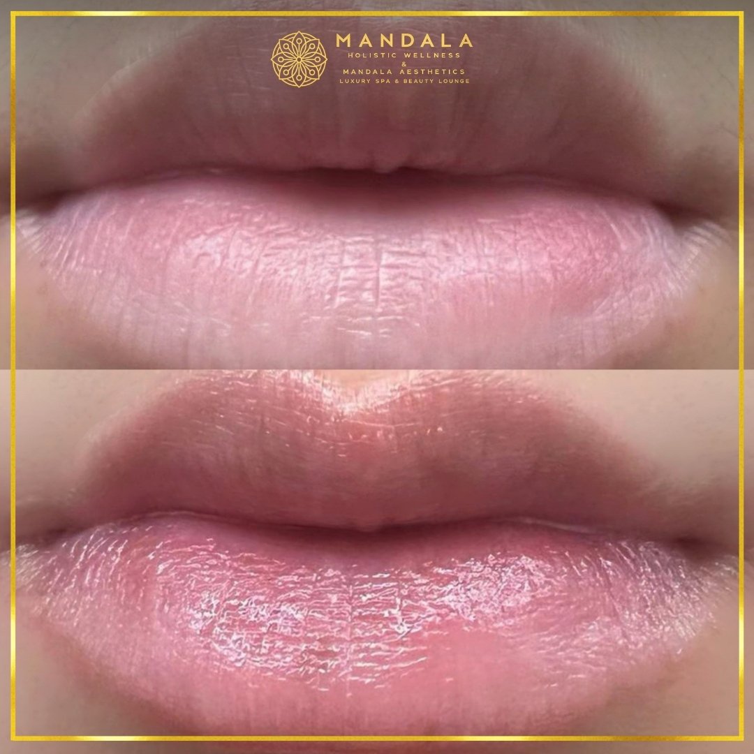 RomaPink Lip Treatment before and after results showing a more even, hydrated lips and naturally pink-looking lip tone at Mandala Aesthetics in Preston, Melbourne.
