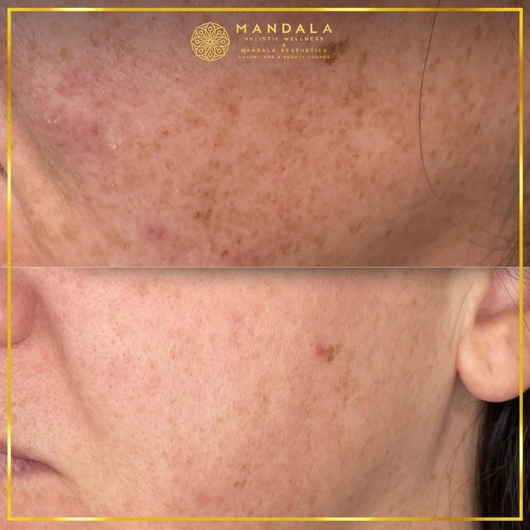 WhiteLab Spot Melanin Removal before and after results showing the appearance of age spots, sun spots , freckles, melasma, pigmentation at Mandala Aesthetics in Preston, Melbourne.