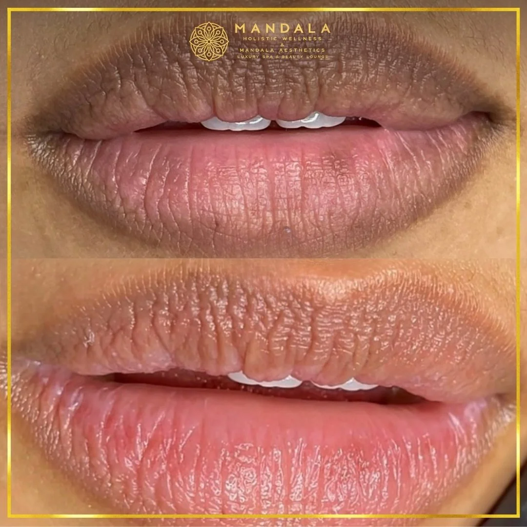 RomaPink Lip Treatment before and after results showing a more even, hydrated lips and naturally pink-looking lip tone at Mandala Aesthetics in Preston, Melbourne.