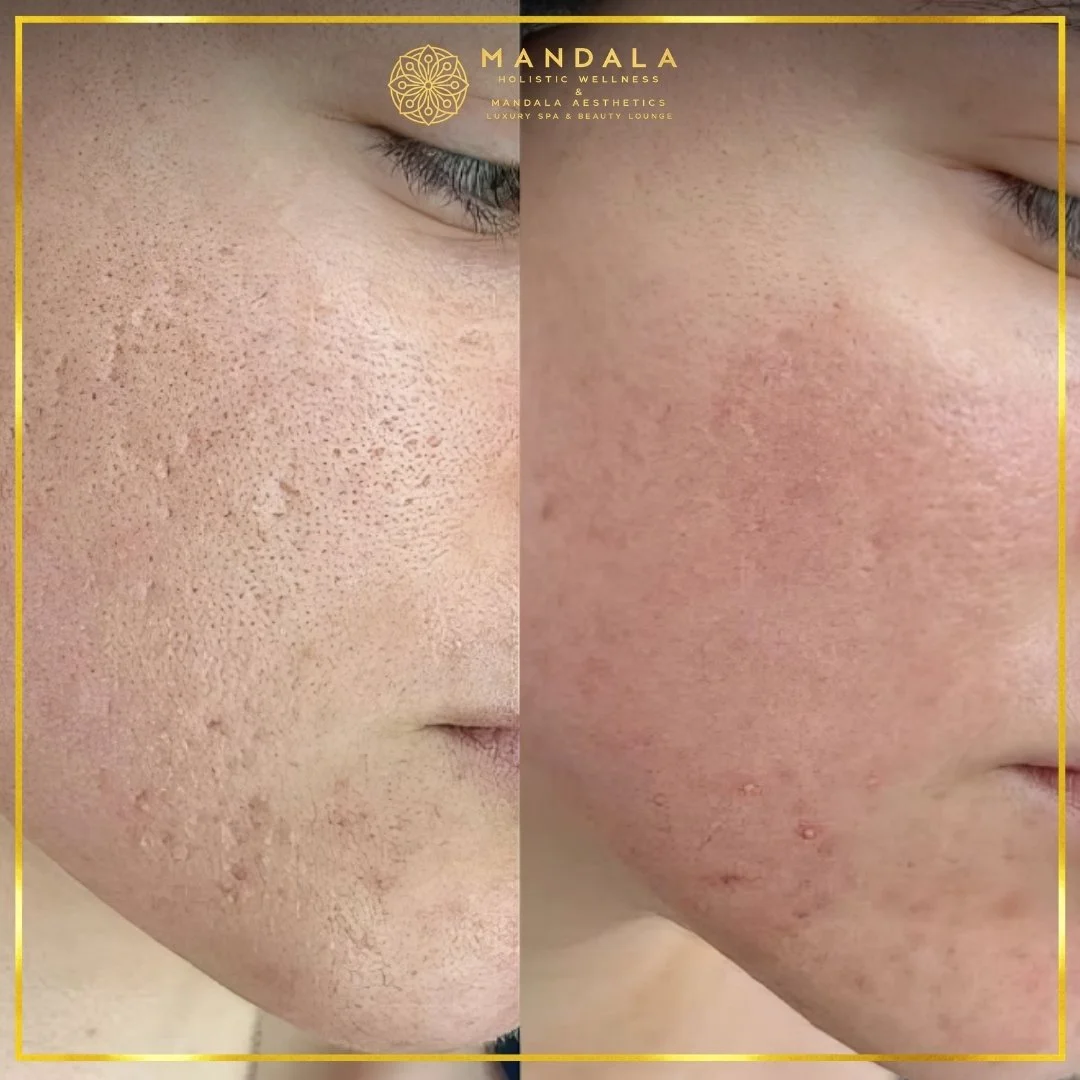 RF Microneedling before and after results showing improved-looking skin texture  and acne scars at Mandala Aesthetics in Preston, Melbourne.