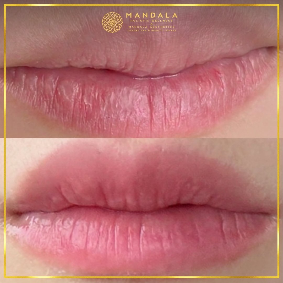 RomaPink Lip Treatment before and after results showing a more even, hydrated lips and naturally pink-looking lip tone at Mandala Aesthetics in Preston, Melbourne.