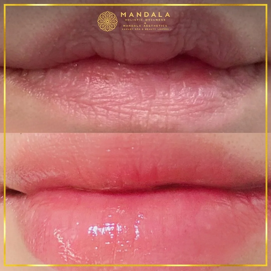 RomaPink Lip Treatment before and after results showing a more even, hydrated lips and naturally pink-looking lip tone at Mandala Aesthetics in Preston, Melbourne.