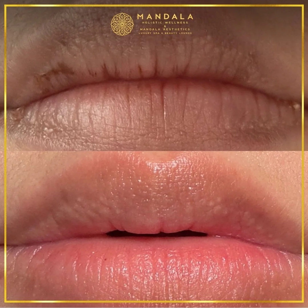 RomaPink Lip Treatment before and after results showing a more even, hydrated lips and naturally pink-looking lip tone at Mandala Aesthetics in Preston, Melbourne.