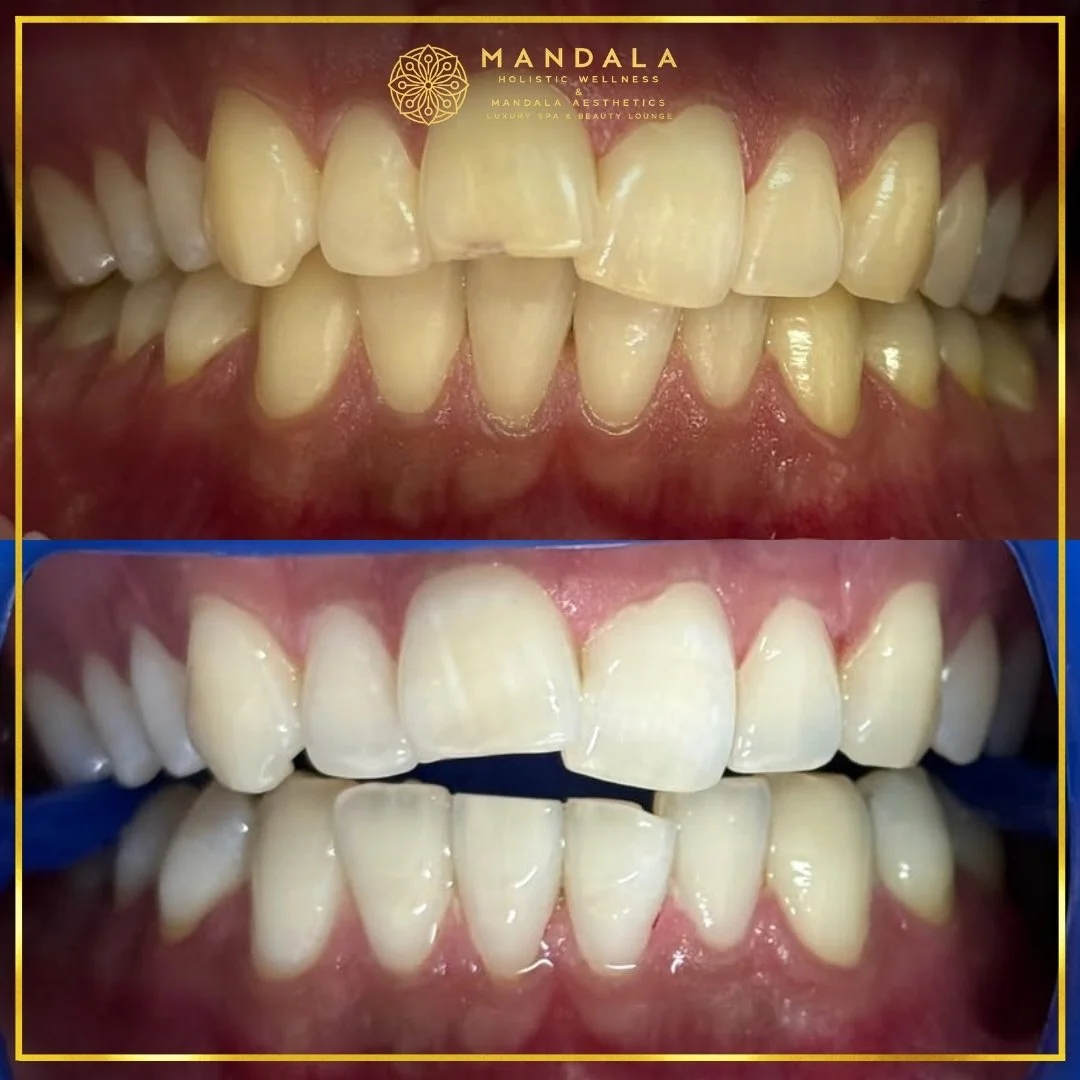 Teeth whitening before and after results showing a visibly white teeth,  brighter-looking smile at Mandala Aesthetics in Preston, Melbourne.