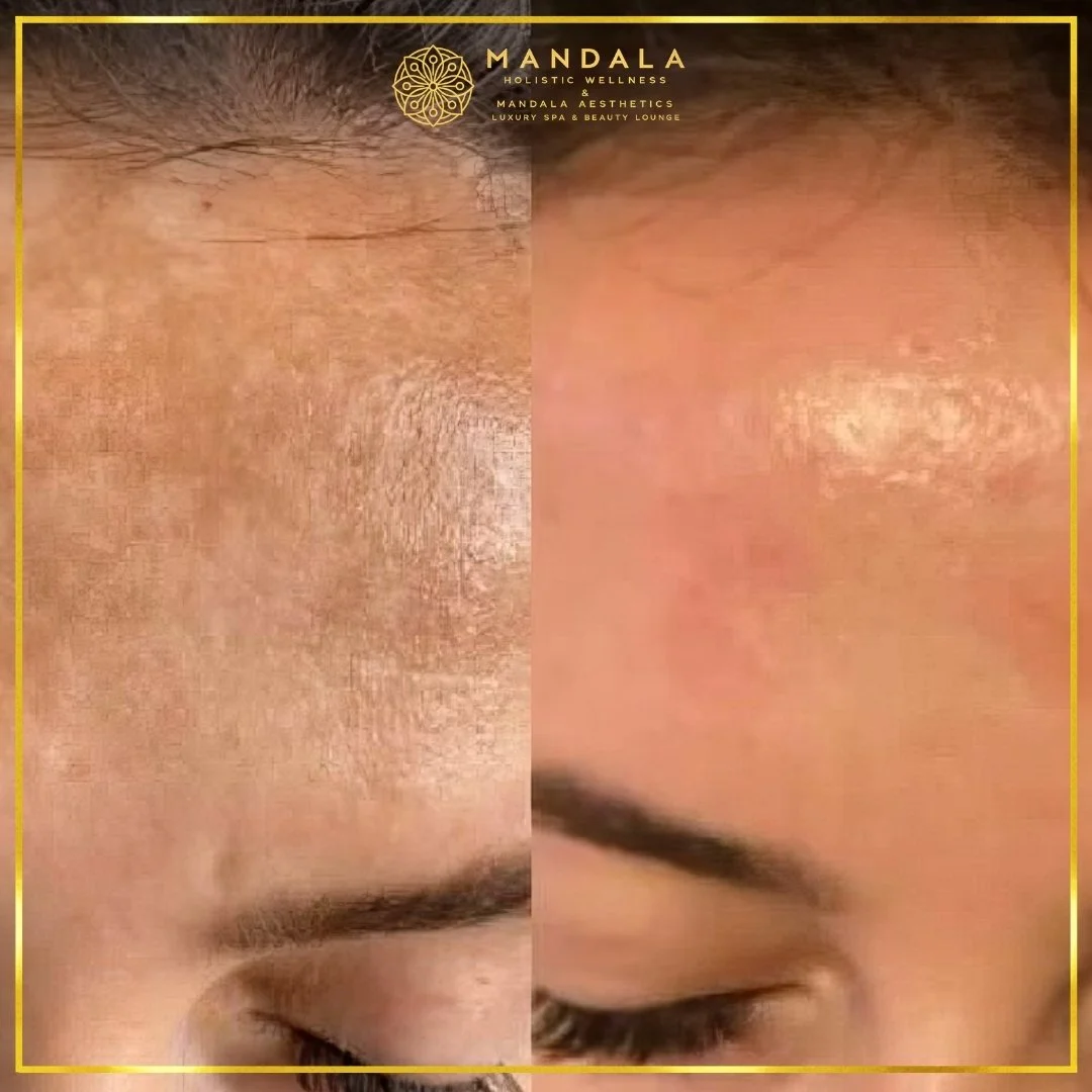 WhiteLab Spot Melanin Removal before and after results showing the appearance of age spots, sun spots , freckles, melasma, pigmentation at Mandala Aesthetics in Preston, Melbourne.