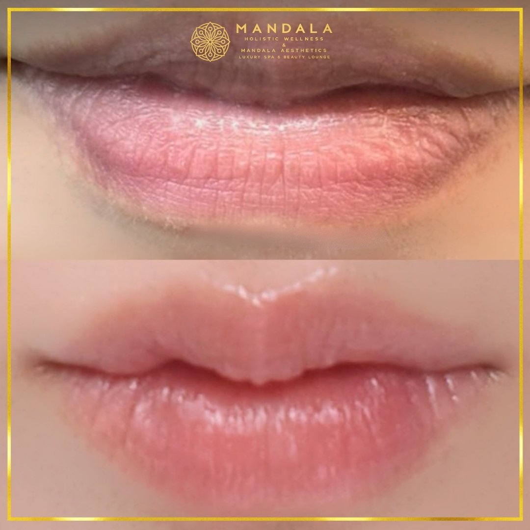 RomaPink Lip Treatment before and after results showing a more even, hydrated lips and naturally pink-looking lip tone at Mandala Aesthetics in Preston, Melbourne.