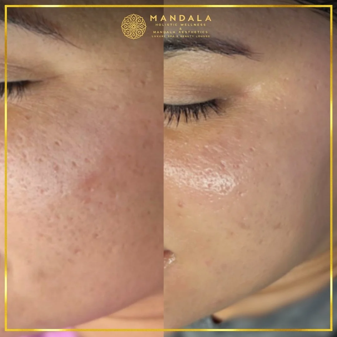 RF Microneedling before and after results showing improved-looking skin texture  and acne scars at Mandala Aesthetics in Preston, Melbourne.