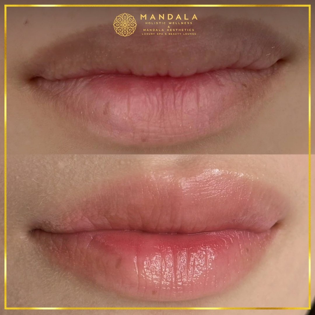 RomaPink Lip Treatment before and after results showing a more even, hydrated lips and naturally pink-looking lip tone at Mandala Aesthetics in Preston, Melbourne.