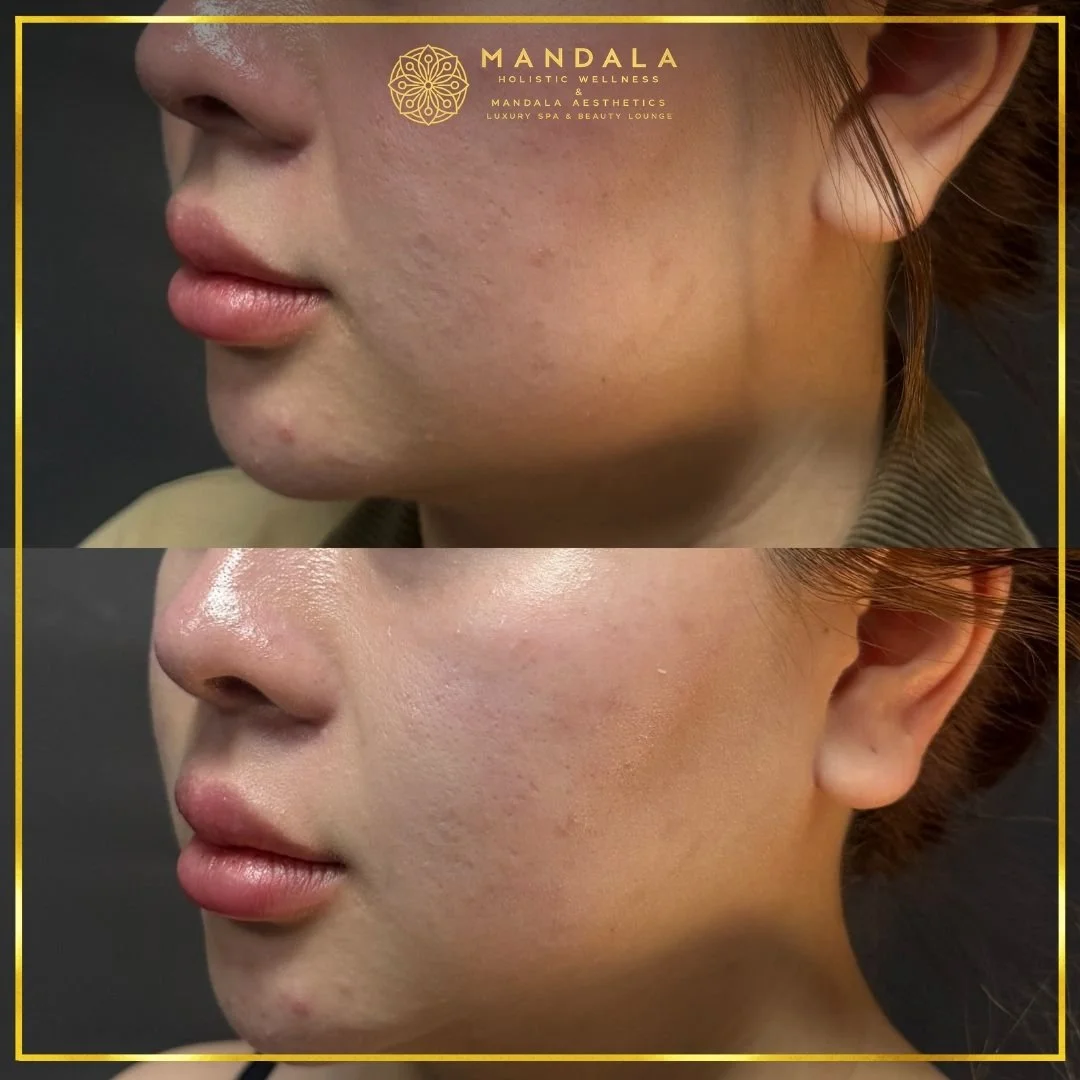 HIFU before and after results showing the lower face, chin and jawline at Mandala Aesthetics in Preston, Melbourne.