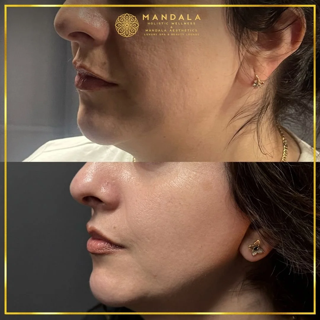 HIFU before and after results showing the lower face, chin and jawline at Mandala Aesthetics in Preston, Melbourne.