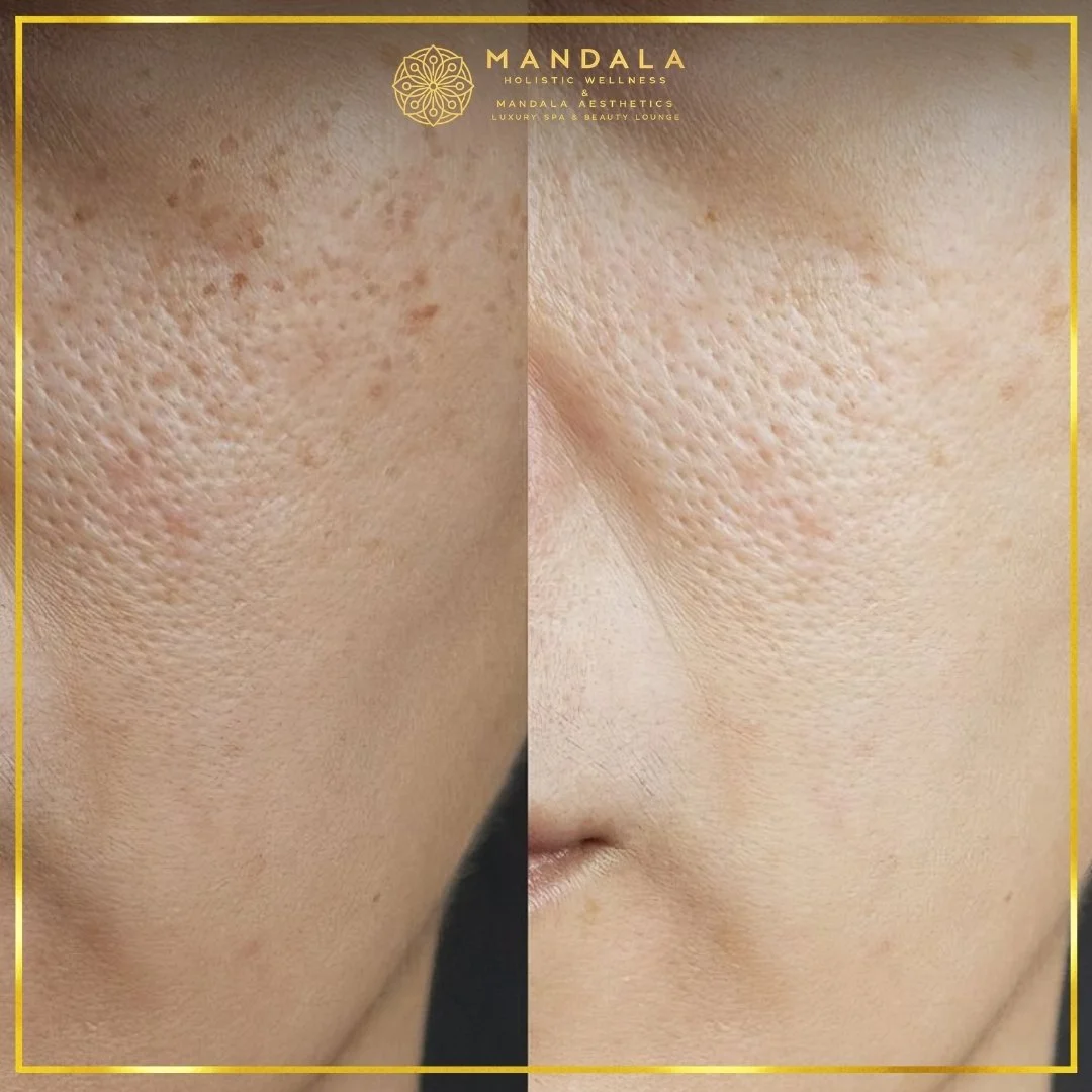 WhiteLab Spot Melanin Removal before and after results showing the appearance of age spots, sun spots , freckles, melasma, pigmentation at Mandala Aesthetics in Preston, Melbourne.