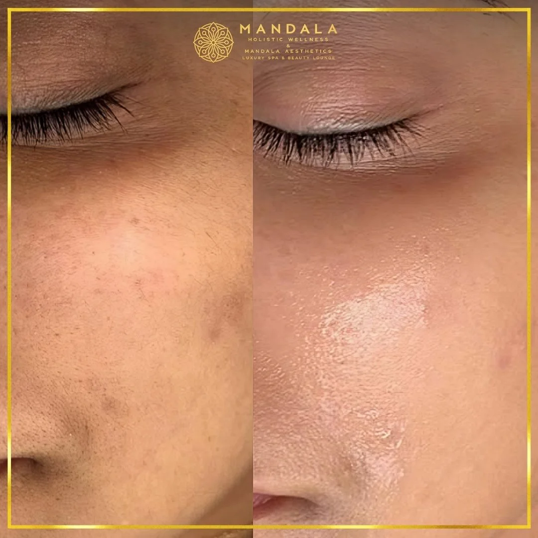 Facial treatment before and after results showing refreshed, hydrated and glowing-looking skin at Mandala Aesthetics in Preston, Melbourne.