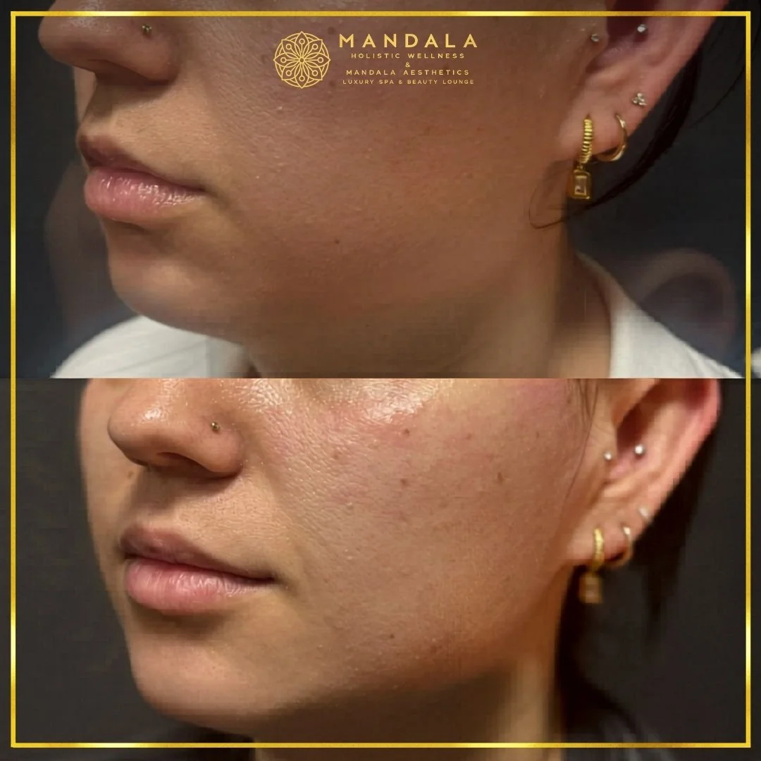 HIFU before and after results showing the lower face, chin and jawline at Mandala Aesthetics in Preston, Melbourne.