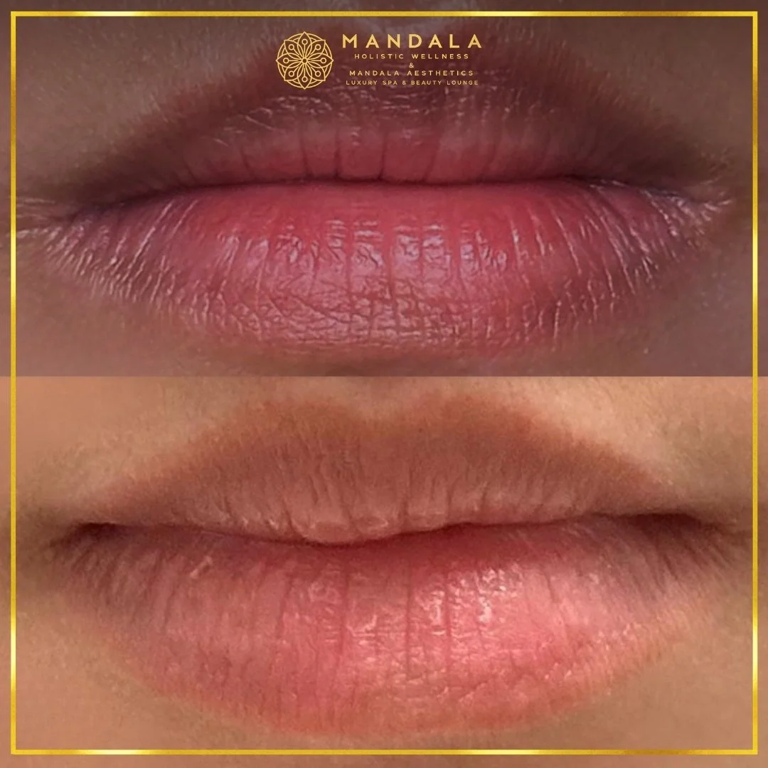 RomaPink Lip Treatment before and after results showing a more even, hydrated lips and naturally pink-looking lip tone at Mandala Aesthetics in Preston, Melbourne.