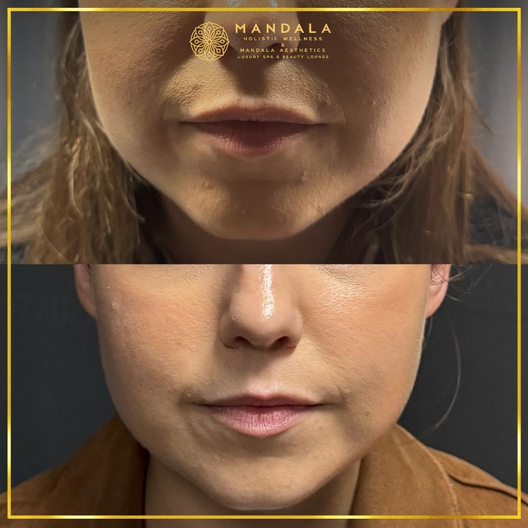 HIFU before and after results showing the lower face, chin and jawline at Mandala Aesthetics in Preston, Melbourne.