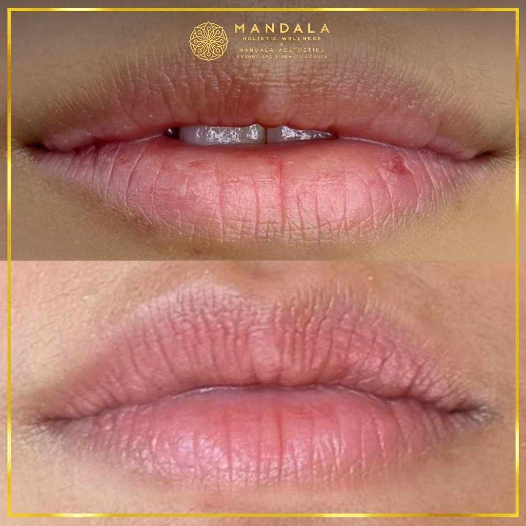 RomaPink Lip Treatment before and after results showing a more even, hydrated lips and naturally pink-looking lip tone at Mandala Aesthetics in Preston, Melbourne.