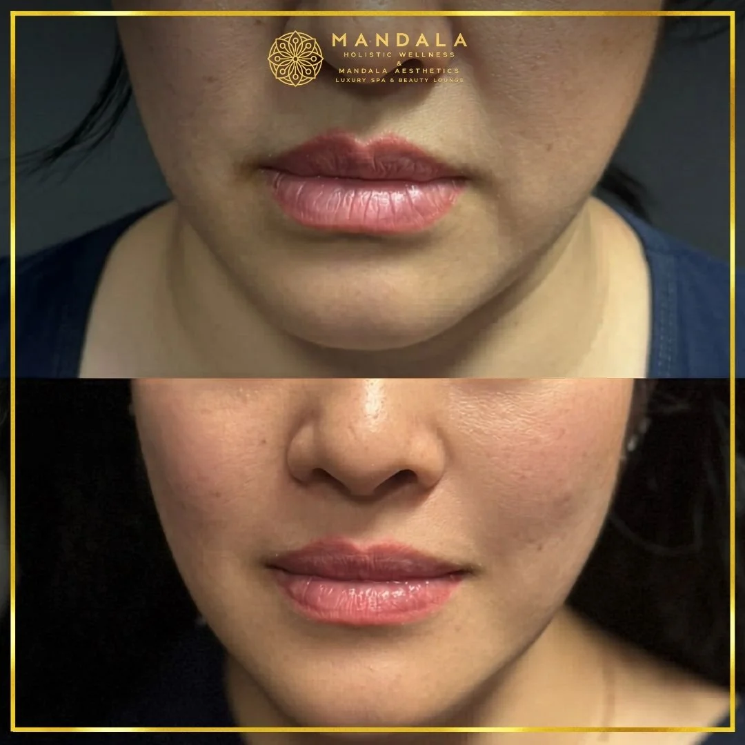 HIFU before and after results showing the lower face, chin and jawline at Mandala Aesthetics in Preston, Melbourne.