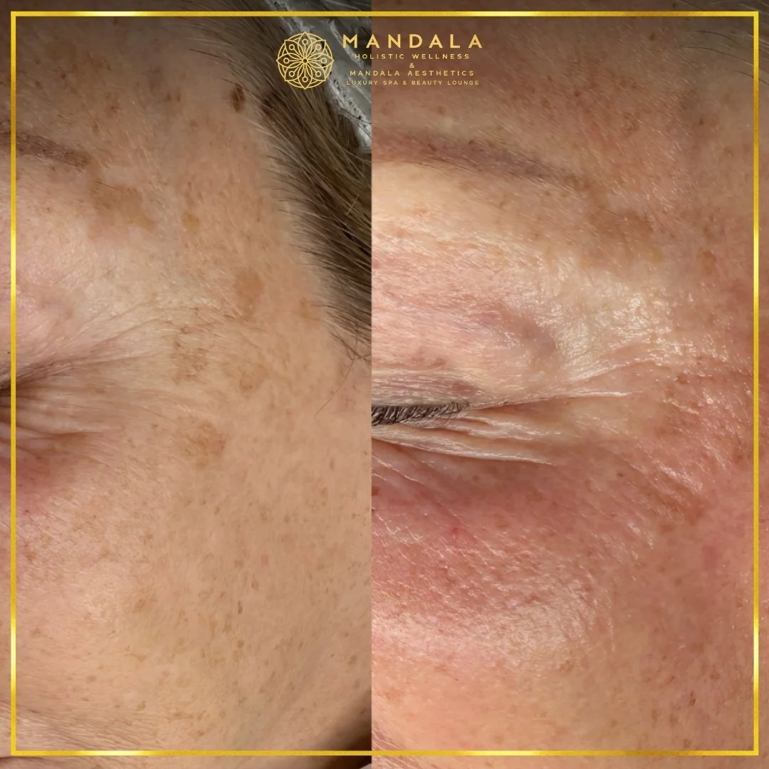WhiteLab Spot Melanin Removal before and after results showing the appearance of age spots, sun spots , freckles, melasma, pigmentation at Mandala Aesthetics in Preston, Melbourne.