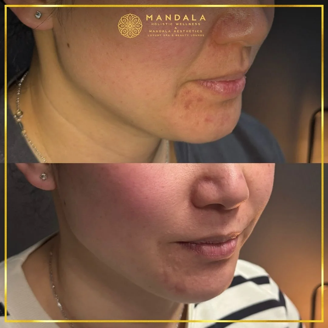 HIFU before and after results showing the lower face, chin and jawline at Mandala Aesthetics in Preston, Melbourne.