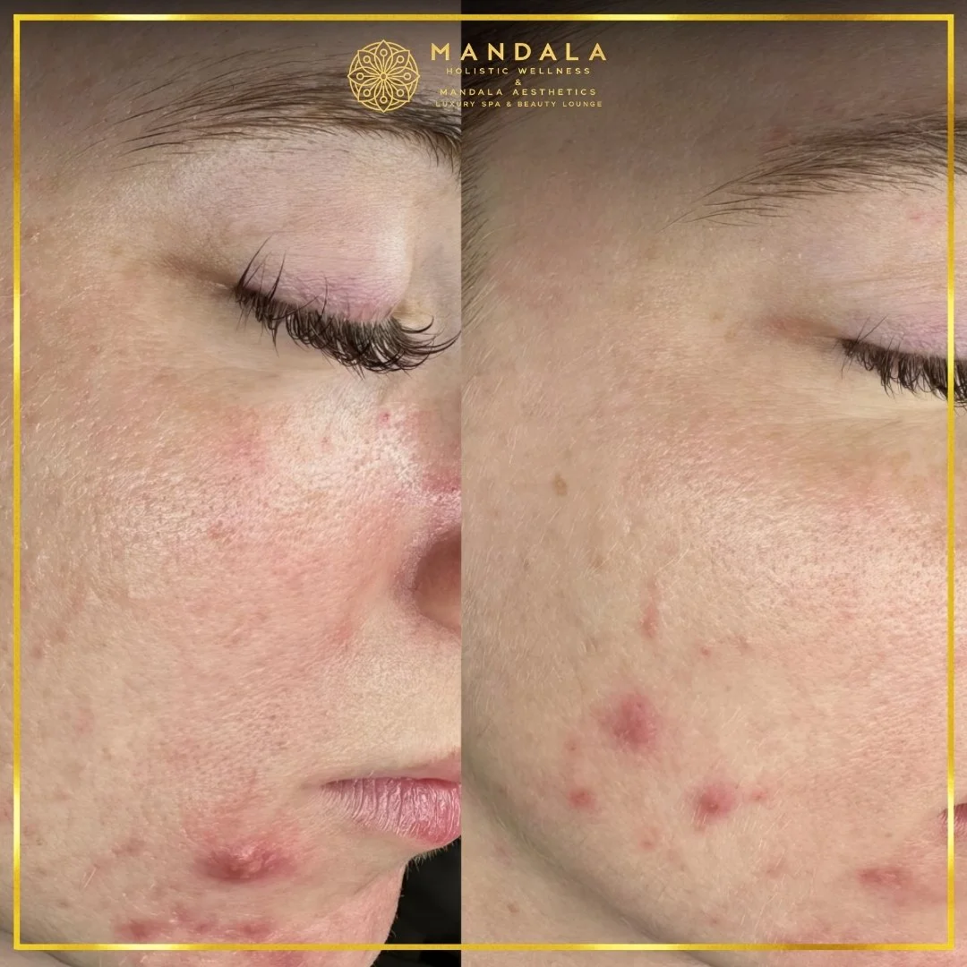 Facial treatment before and after results showing refreshed, hydrated and glowing-looking skin at Mandala Aesthetics in Preston, Melbourne.