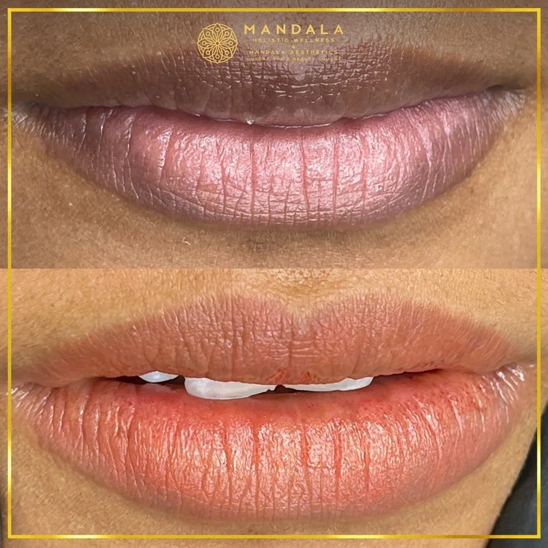 RomaPink Lip Treatment before and after results showing a more even, hydrated lips and naturally pink-looking lip tone at Mandala Aesthetics in Preston, Melbourne.