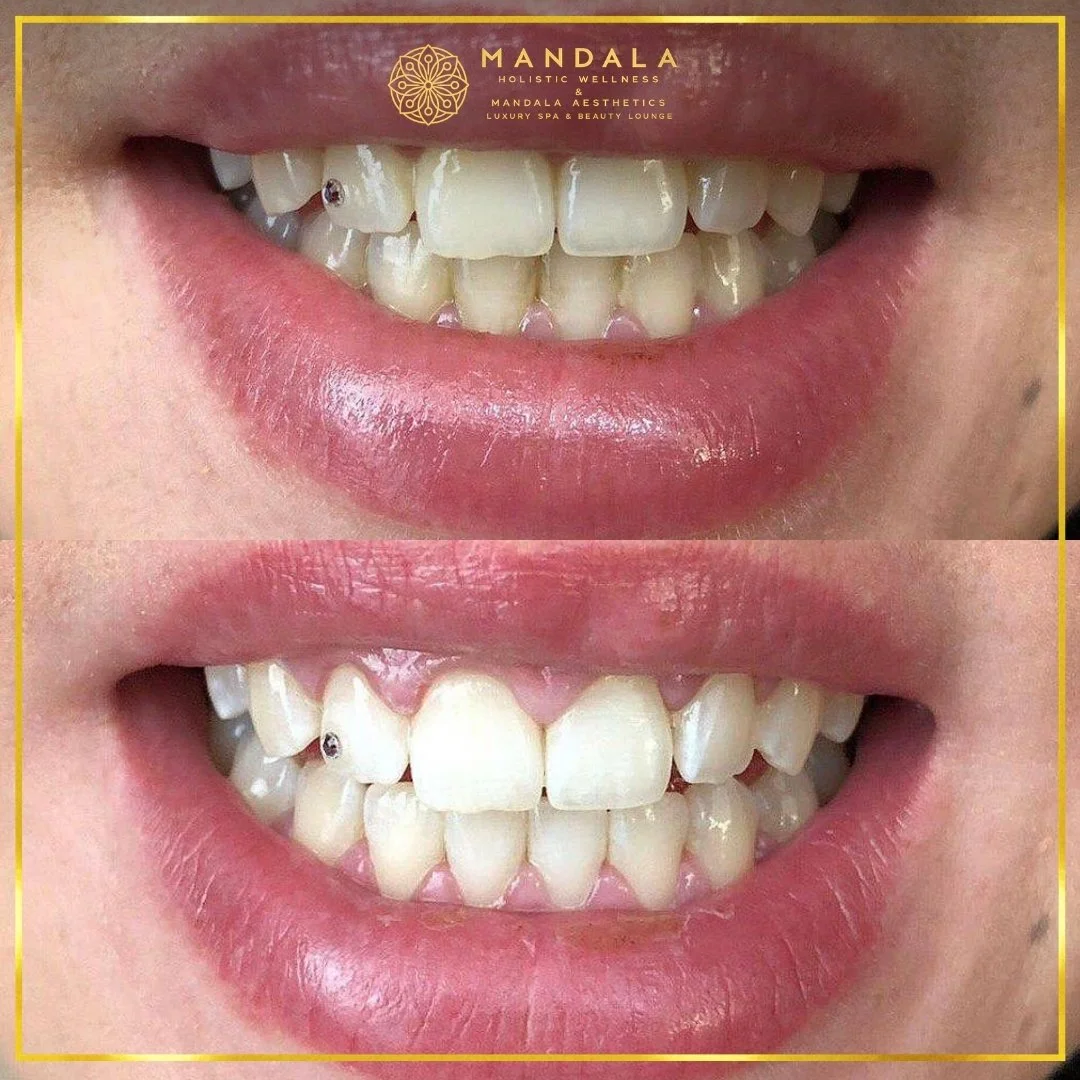 Teeth whitening before and after results showing a visibly white teeth,  brighter-looking smile at Mandala Aesthetics in Preston, Melbourne.