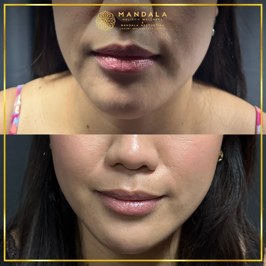 HIFU before and after results showing the lower face, chin and jawline at Mandala Aesthetics in Preston, Melbourne.