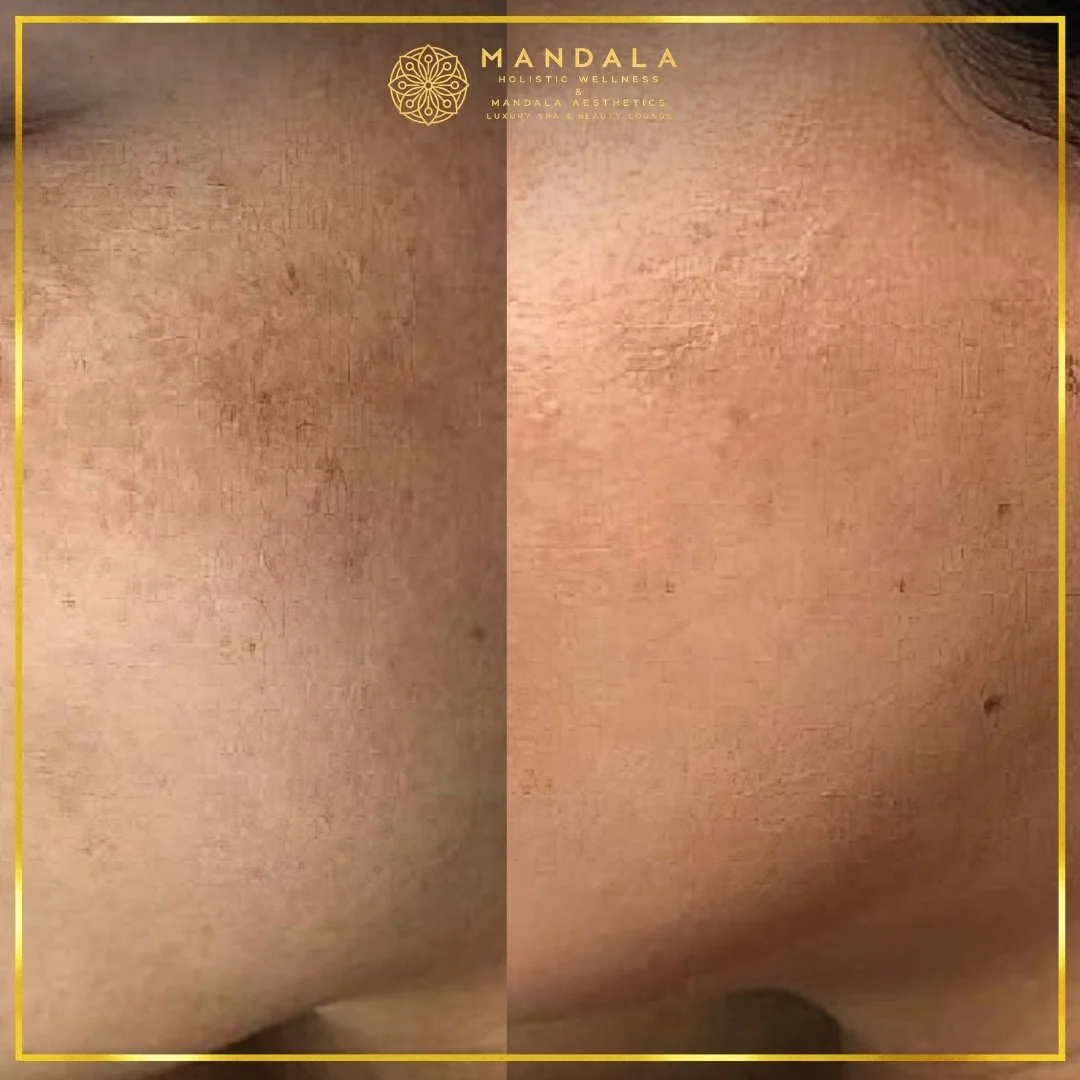 WhiteLab Spot Melanin Removal before and after results showing the appearance of age spots, sun spots , freckles, melasma, pigmentation at Mandala Aesthetics in Preston, Melbourne.