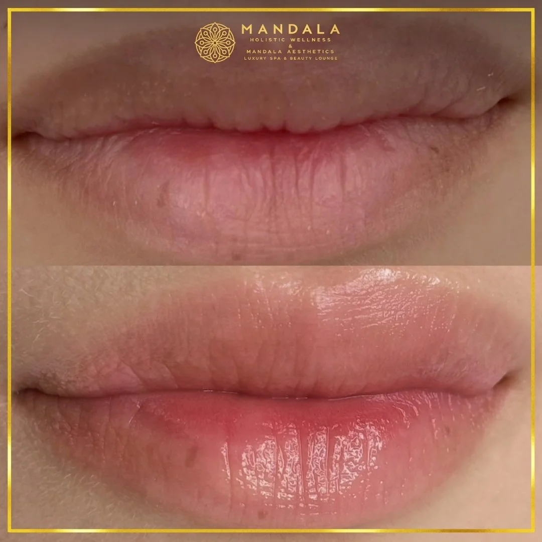 RomaPink Lip Treatment before and after results showing a more even, hydrated lips and naturally pink-looking lip tone at Mandala Aesthetics in Preston, Melbourne.