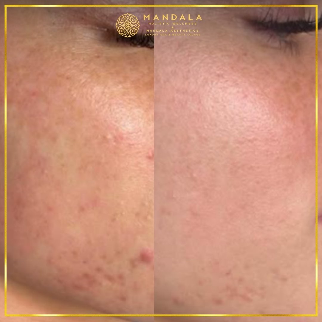 Facial treatment before and after results showing refreshed, hydrated and glowing-looking skin at Mandala Aesthetics in Preston, Melbourne.