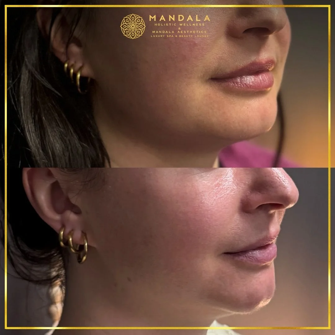HIFU before and after results showing the lower face, chin and jawline at Mandala Aesthetics in Preston, Melbourne.