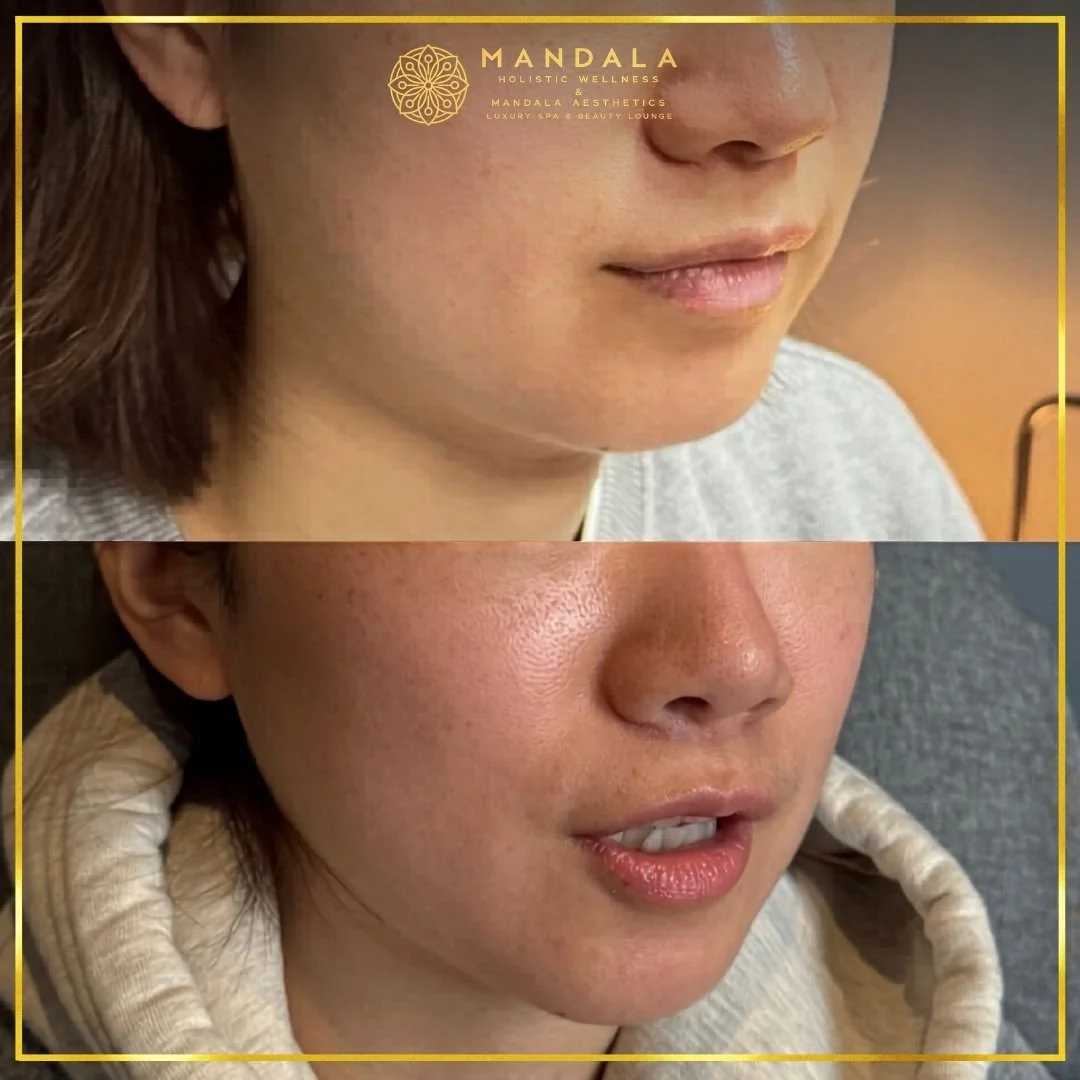 HIFU before and after results showing the lower face, chin and jawline at Mandala Aesthetics in Preston, Melbourne.