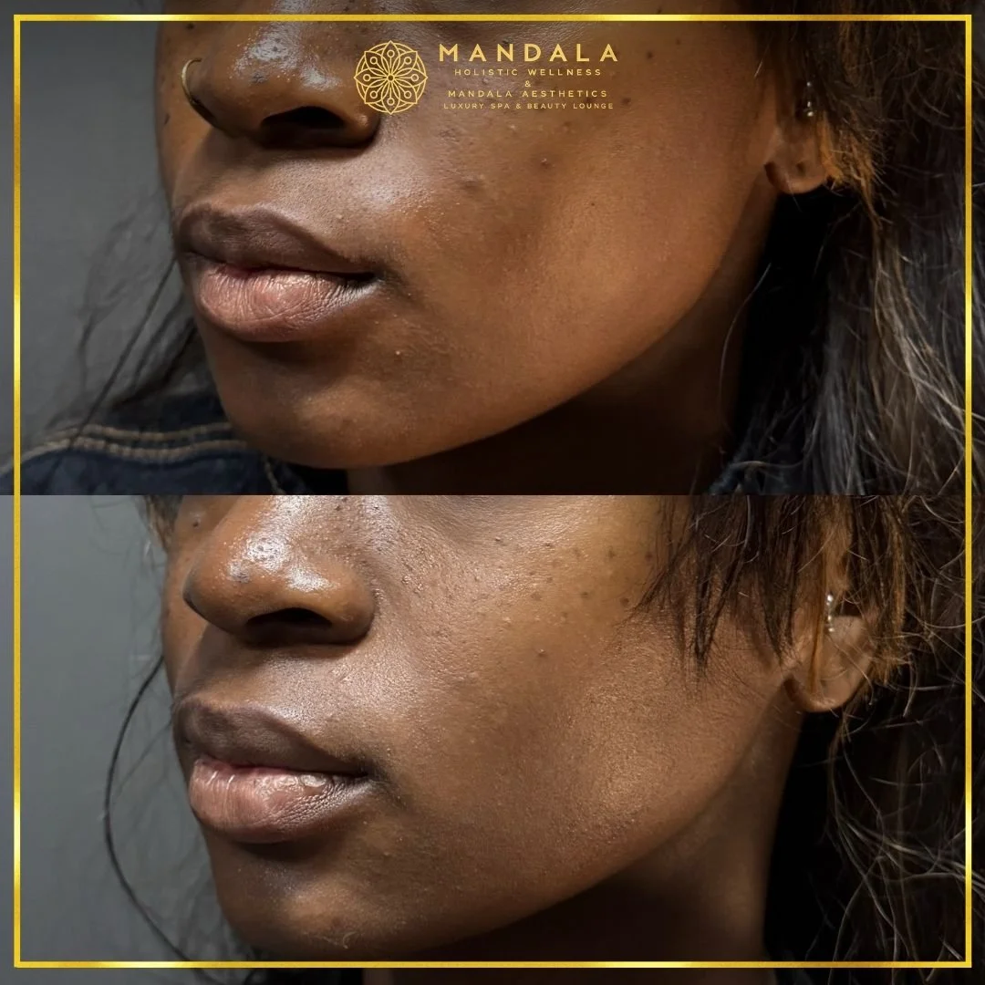 HIFU before and after results showing the lower face, chin and jawline at Mandala Aesthetics in Preston, Melbourne.