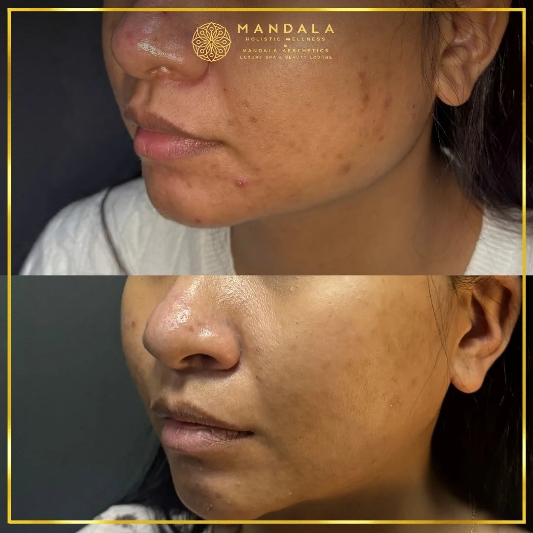 HIFU before and after results showing the lower face, chin and jawline at Mandala Aesthetics in Preston, Melbourne.