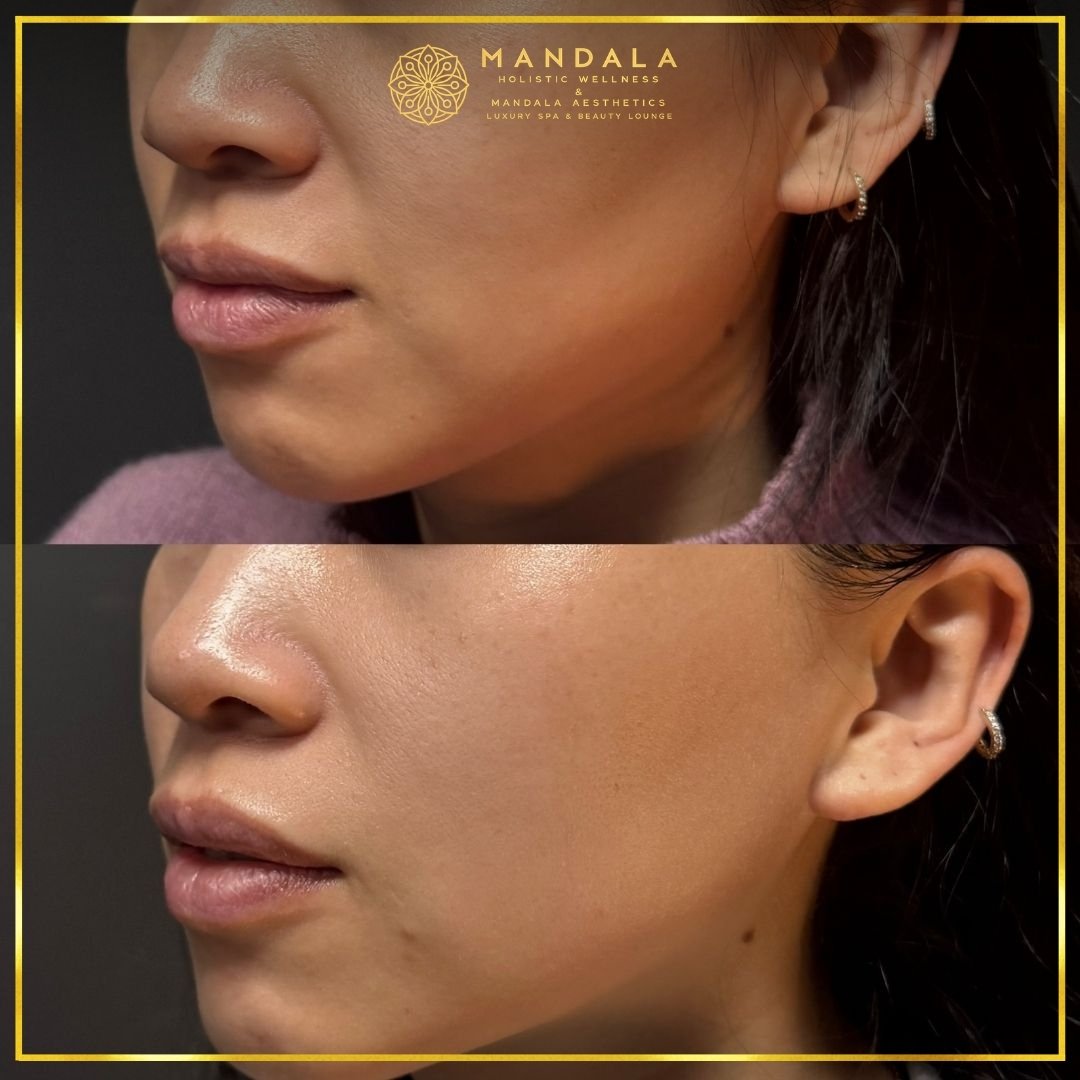 HIFU before and after results showing the lower face, chin and jawline at Mandala Aesthetics in Preston, Melbourne.
