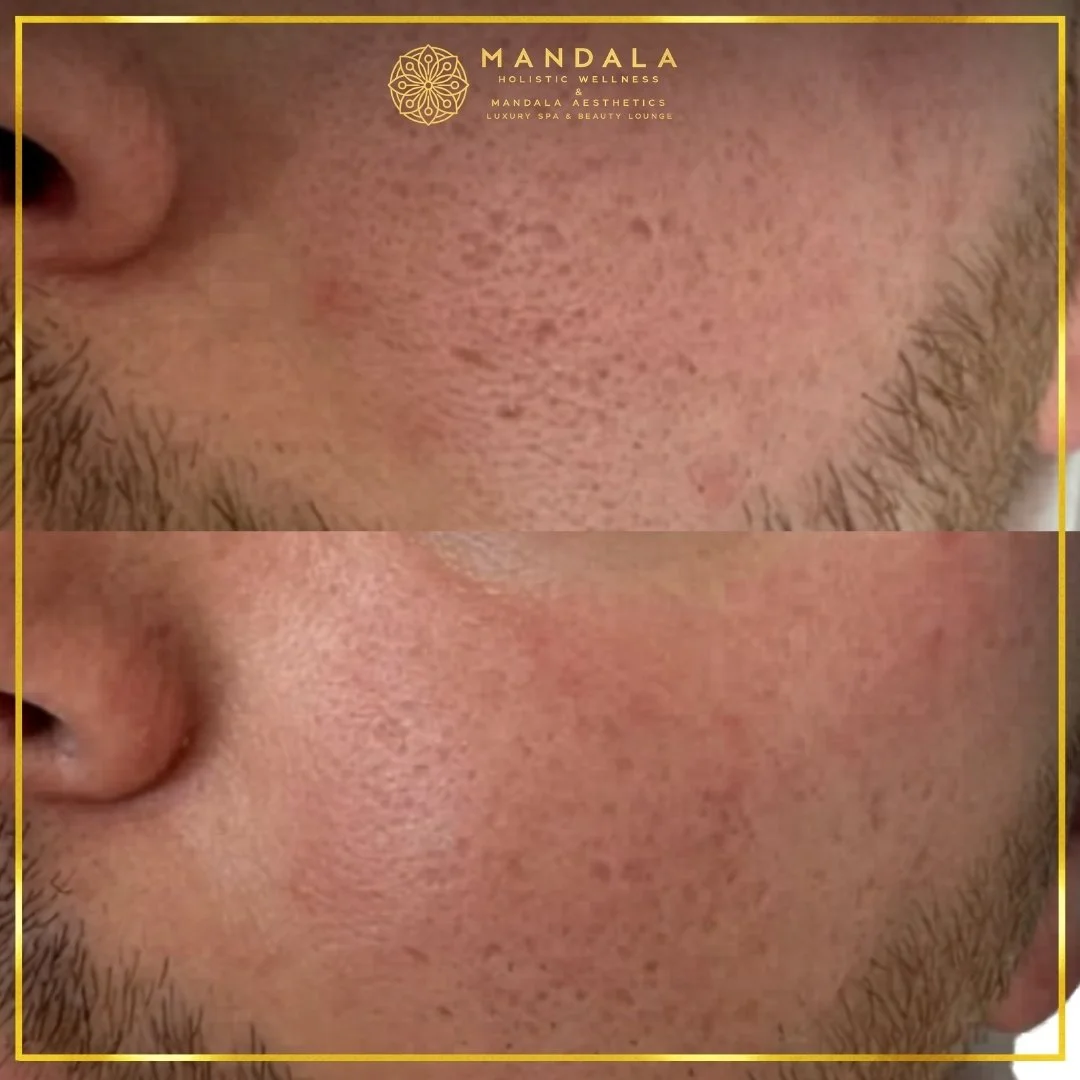 RF Microneedling before and after results showing improved-looking skin texture  and acne scars at Mandala Aesthetics in Preston, Melbourne.