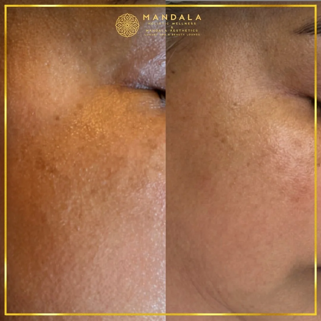 Facial treatment before and after results showing refreshed, hydrated and glowing-looking skin at Mandala Aesthetics in Preston, Melbourne.